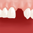 Dent manquante