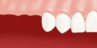 Edentement latéral